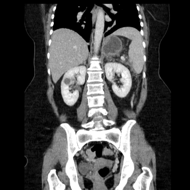 Acute pancreatitis - Balthazar C (Radiopaedia 26569-26714 Coronal C+ portal venous phase 45).jpg