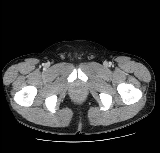 Acute pancreatitis - Balthazar E (Radiopaedia 23080-23110 Axial C+ portal venous phase 77).jpg