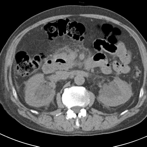 File:Acute pancreatitis and walled-off necrosis (Radiopaedia 29888-30403 Axial non-contrast 28).jpg