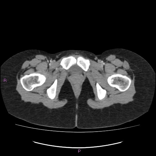 File:Acute pancreatitis secondary to stone at minor papilla and pancreatic divisum (Radiopaedia 76570-88333 Axial C+ portal venous phase 83).jpg