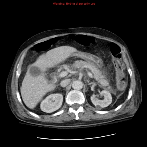 File:Acute pancreatitis with incidental pancreatic lipoma (Radiopaedia 10190-10730 Axial C+ portal venous phase 22).jpg