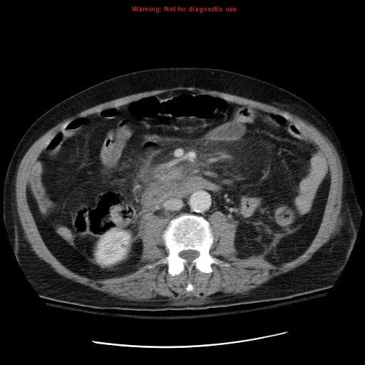 File:Acute pancreatitis with incidental pancreatic lipoma (Radiopaedia 10190-10730 Axial C+ portal venous phase 38).jpg
