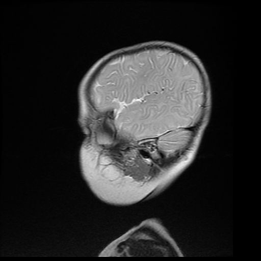 File:Acute phase of hemiconvulsion-hemiplegia epilepsy syndrome (Radiopaedia 29309-29745 Sagittal T2 18).jpg