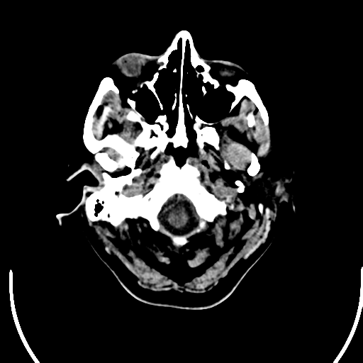 File:Acute pontine infarct from vertebral artery dissection (Radiopaedia 34111-35369 Axial non-contrast 2).png