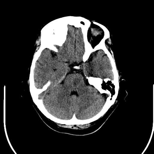 File:Acute pontine infarct from vertebral artery dissection (Radiopaedia 34111-35369 Axial non-contrast 8).png