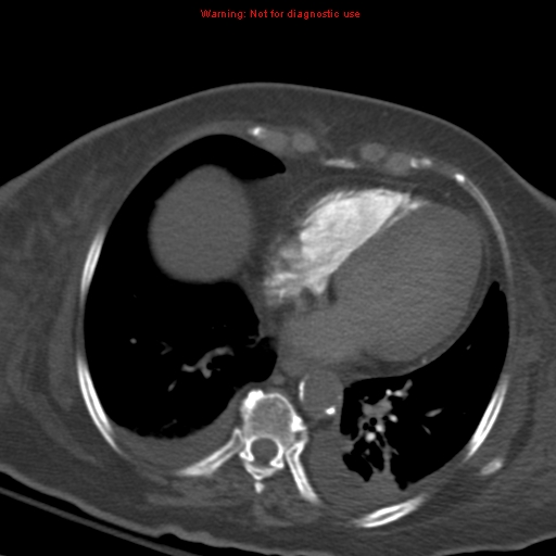 Acute pulmonary embolism (Radiopaedia 13286-13289 Axial C+ CTPA 46).jpg