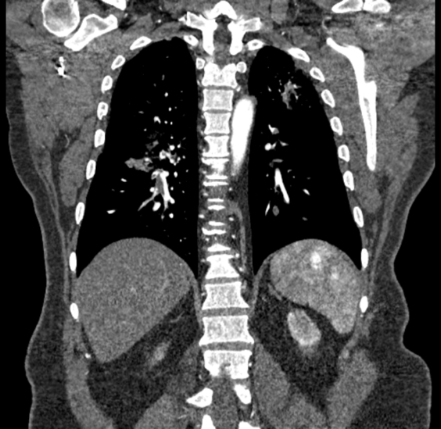 Acute pulmonary embolism with pulmonary infarcts (Radiopaedia 77688-89908 Coronal C+ CTPA 73).jpg