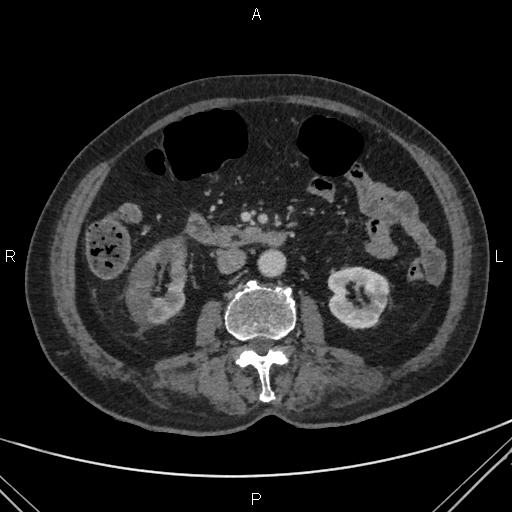 File:Acute renal artery occlusion (Radiopaedia 86586-102682 Axial C+ portal venous phase 40).jpg