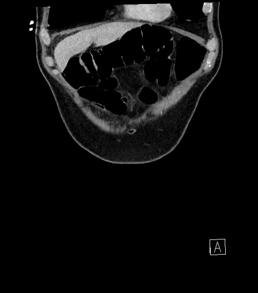 Acute renal infarction (Radiopaedia 59375-66736 Coronal C+ portal venous phase 12).jpg