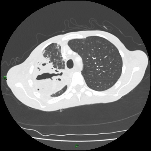 Acute right lung abscess (Radiopaedia 34806-36258 Axial lung window 47).jpg