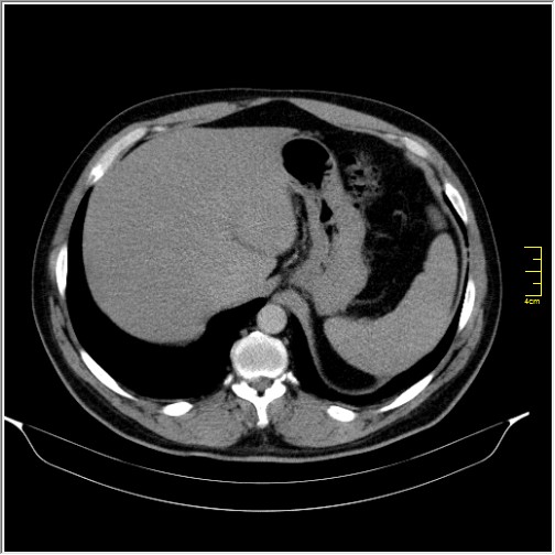 Acute right sided diverticulitis (Radiopaedia 65249-74268 Axial C+ portal venous phase 12).JPG