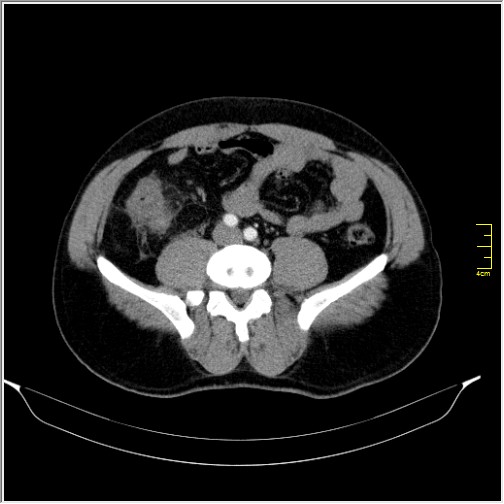 Acute right sided diverticulitis (Radiopaedia 65249-74268 Axial C+ portal venous phase 50).JPG