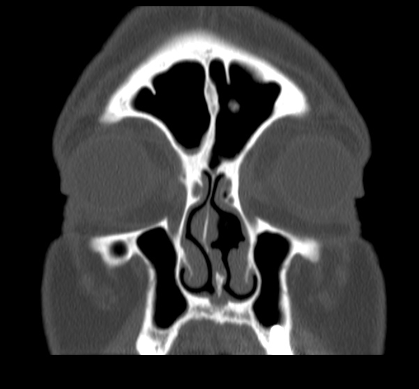 Acute sinusitis (Radiopaedia 23161-23215 Coronal bone window 24).jpg