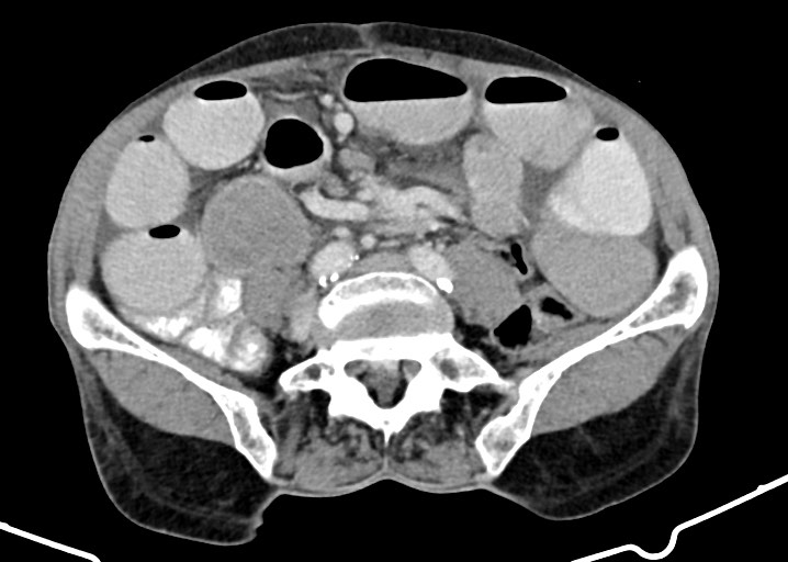Acute small bowel (ileal) volvulus (Radiopaedia 71740-82139 Axial C+ portal venous phase 135).jpg