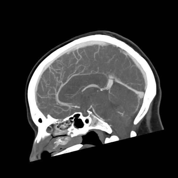 Acute subarachnoid hemorrhage and accessory anterior cerebral artery (Radiopaedia 69231-79009 Sagittal C+ arterial phase 37).jpg