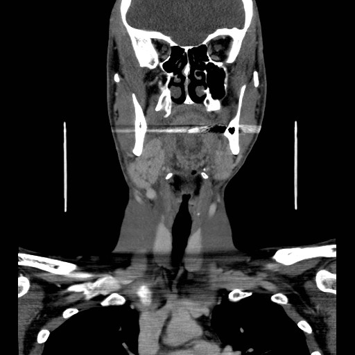 File:Acute submandibular sialadenitis secondary to ductal stone (Radiopaedia 27999-28267 D 24).jpg