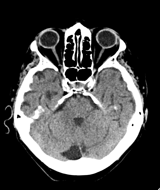 Acute traumatic subdural hematoma (Radiopaedia 82921-97257 Axial non-contrast 45).jpg