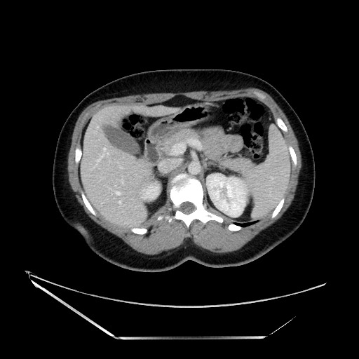 Acute uncomplicated appendicitis (Radiopaedia 73704-84499 Axial C+ portal venous phase 47).jpg