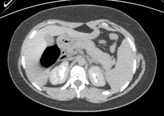 Acute unilateral nonhemorrhagic adrenal infarction (Radiopaedia 67560-76957 Axial renal excretory phase 35).jpg