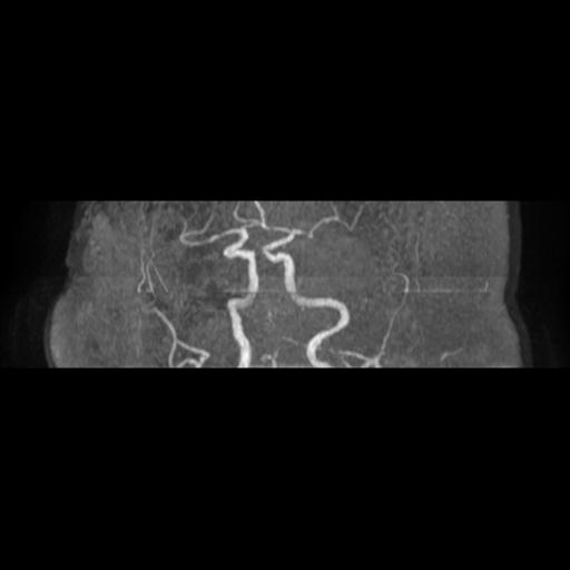 Acute vertebrobasilar ischemic infarction (Radiopaedia 25220-25474 Axial MRA 7).jpg