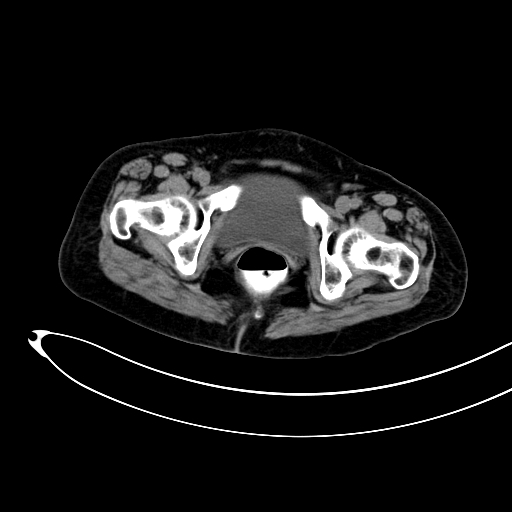 Adenocarcinoma colon with intussusception (Radiopaedia 86006-101922 Axial non-contrast 62).jpg