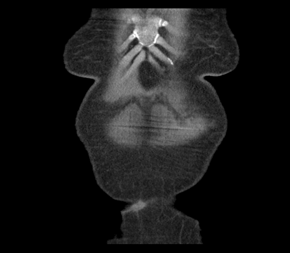 Adenocarcinoma of cecum (Radiopaedia 59222-66549 Coronal C+ arterial phase 2).jpg