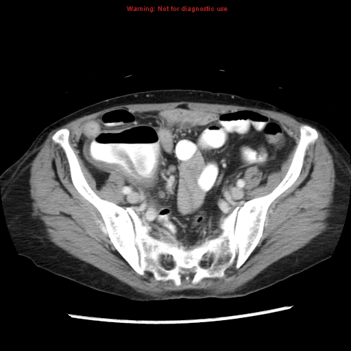 File:Adenocarcinoma of the colon (Radiopaedia 8191-9039 Axial liver window 58).jpg