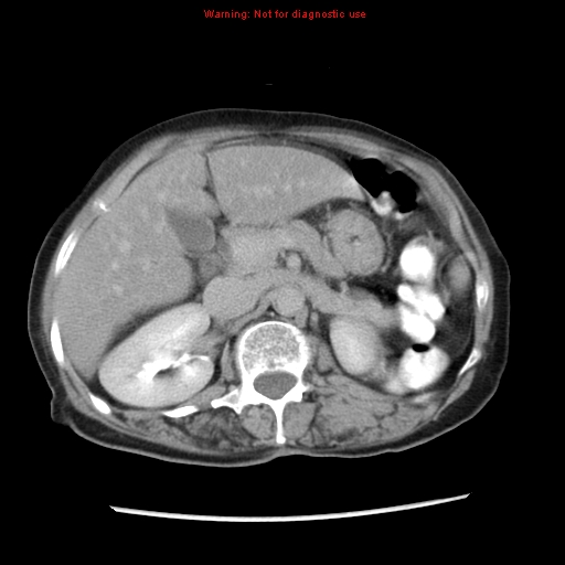File:Adenocarcinoma of the colon (Radiopaedia 8191-9039 Axial renal excretory phase 12).jpg
