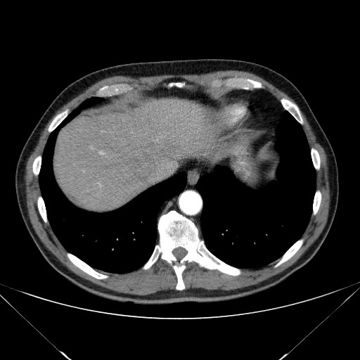 File:Adenocarcinoma of the lung (Radiopaedia 59871-67325 Axial C+ arterial phase 78).jpg