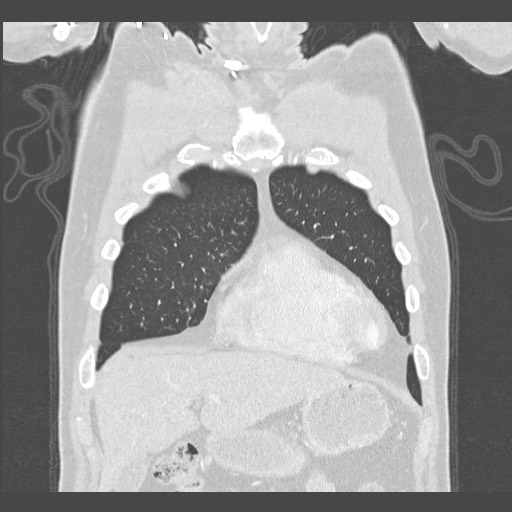 Adenocarcinoma of the lung (Radiopaedia 59871-67325 Coronal lung window 7).jpg