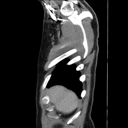 Adenocarcinoma of the lung (Radiopaedia 59871-67325 Sagittal C+ arterial phase 5).jpg