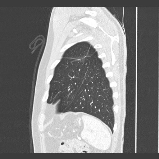 Adenocarcinoma of the lung (Radiopaedia 59871-67325 Sagittal lung window 87).jpg