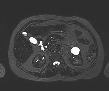 File:Adenomyomatosis of the gallbladder (Radiopaedia 50246-55587 Axial 43).png