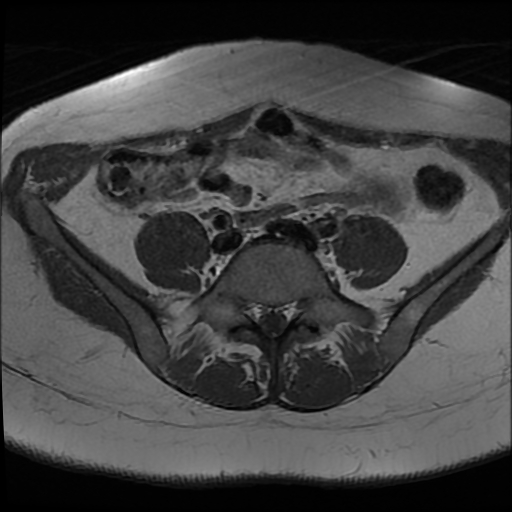 File:Adenomyosis-scar endometriosis (Radiopaedia 65863-75022 Axial T1 1).jpg