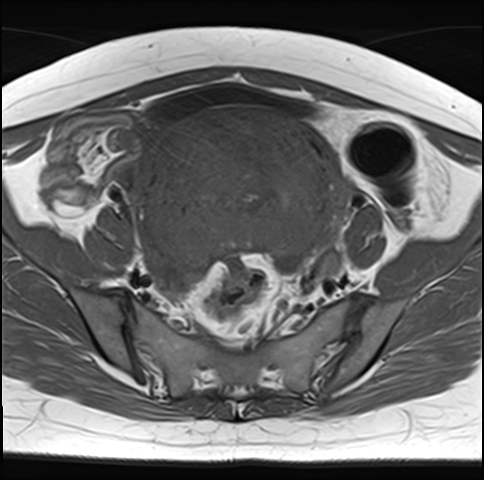 File:Adenomyosis - ovarian endometriomas (Radiopaedia 67031-76350 Axial T1 10).jpg