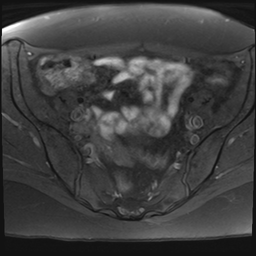 File:Adenomyosis and endometriotic cysts (Radiopaedia 82300-96367 Axial T1 fat sat 22).jpg