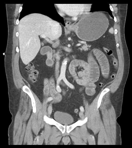 File:Adhesions within abdominal wall hernia (Radiopaedia 58283-65394 Coronal C+ portal venous phase 37).png