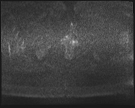 Adnexal multilocular cyst (O-RADS US 3- O-RADS MRI 3) (Radiopaedia 87426-103754 Axial DWI 90).jpg