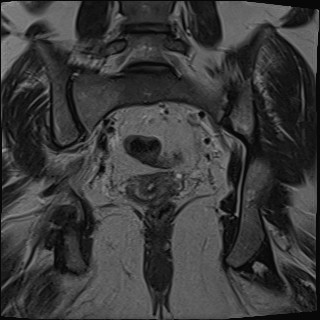 File:Adnexal multilocular cyst (O-RADS US 3- O-RADS MRI 3) (Radiopaedia 87426-103754 Coronal T2 23).jpg