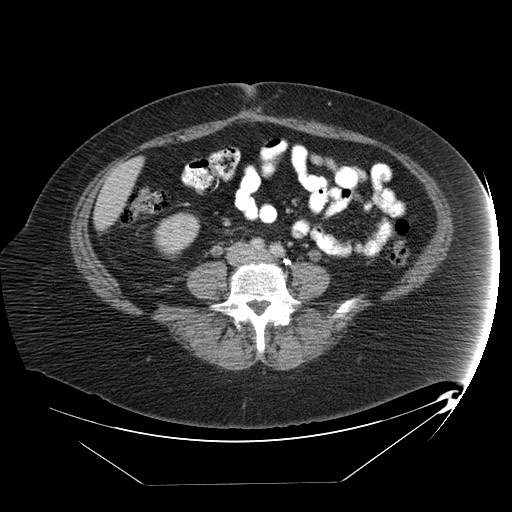 Adrenal angiosarcoma (Radiopaedia 81081-94671 Axial C+ portal venous phase 51).jpg