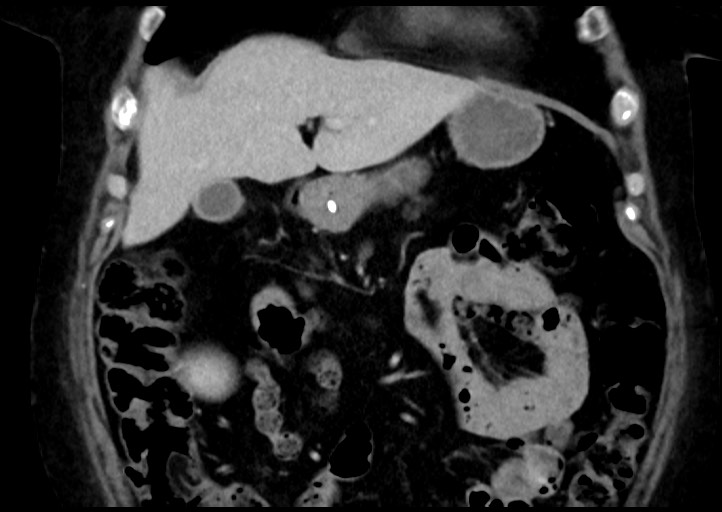 Adrenal cortical carcinoma (Radiopaedia 64017-72769 Coronal C+ portal venous phase 16).jpg