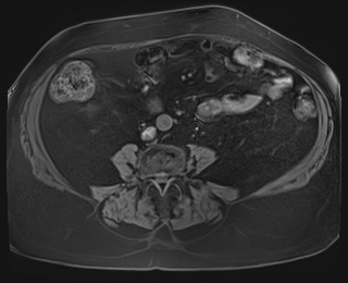 Adrenal cortical carcinoma (Radiopaedia 64017-72770 Axial T1 fat sat 65).jpg