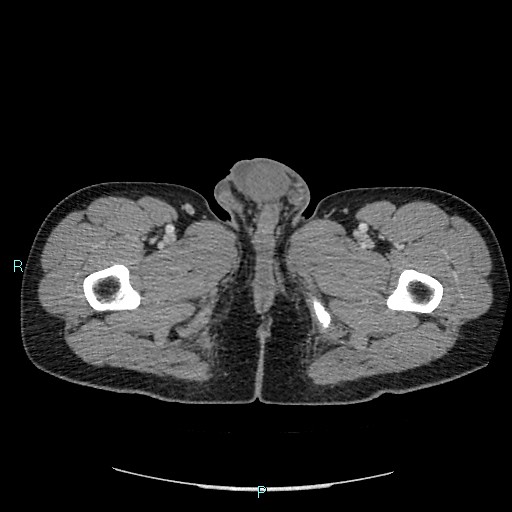 Adrenal cystic lymphangioma (Radiopaedia 83161-97534 Axial C+ portal venous phase 113).jpg
