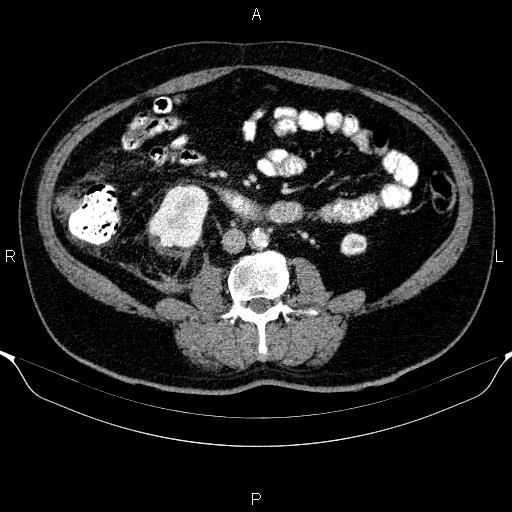 Adrenal hemorrhage (Radiopaedia 62622-70916 Axial C+ portal venous phase 105).jpg