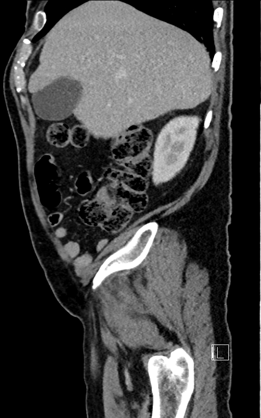 Adrenal lymphoma (Radiopaedia 73730-84529 Sagittal C+ portal venous phase 21).jpg
