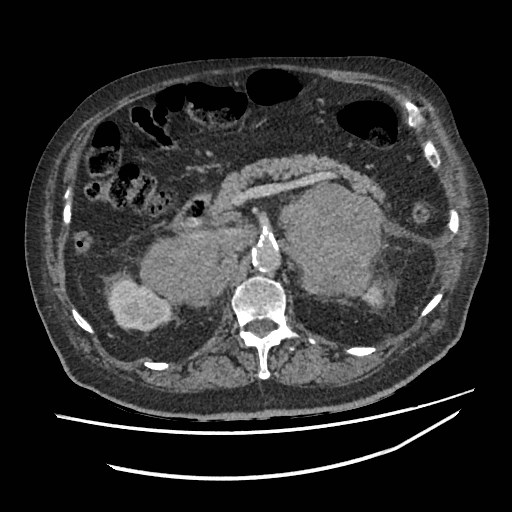 Adrenal lymphoma (Radiopaedia 84145-99415 Axial C+ portal venous phase 42).jpg