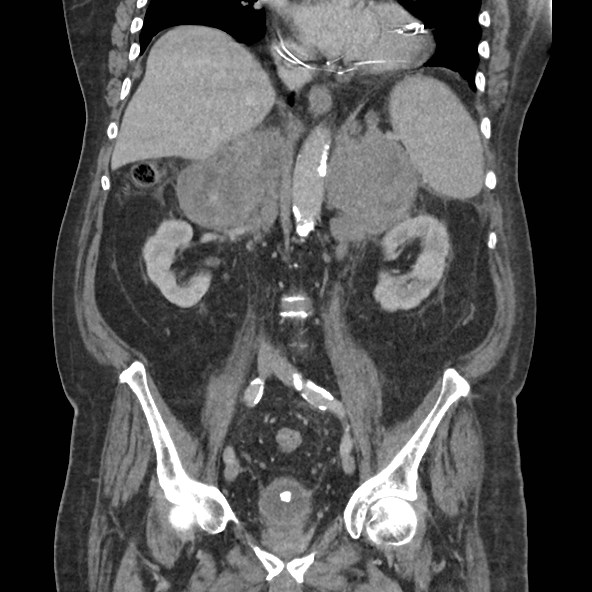 Adrenal lymphoma (Radiopaedia 84145-99415 Coronal C+ portal venous phase 49).jpg
