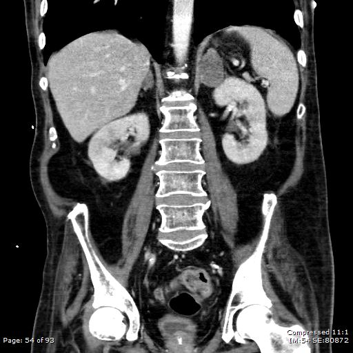 Adrenal metastasis (Radiopaedia 78425-91079 Sagittal C+ portal venous phase 41).jpg