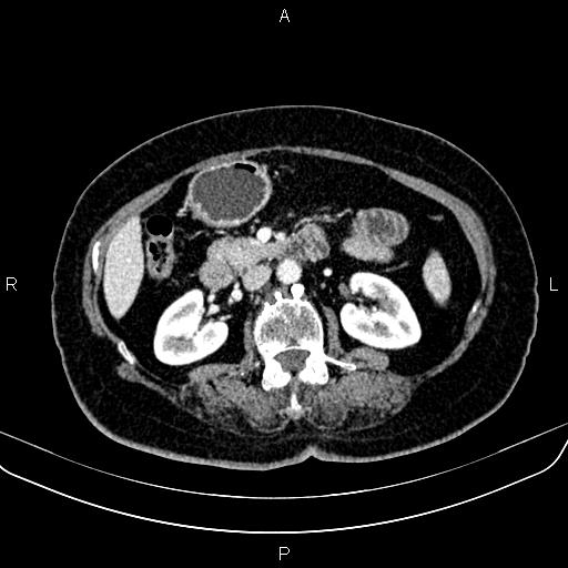 Adrenal myelolipoma (Radiopaedia 82742-96986 Axial renal cortical phase 77).jpg
