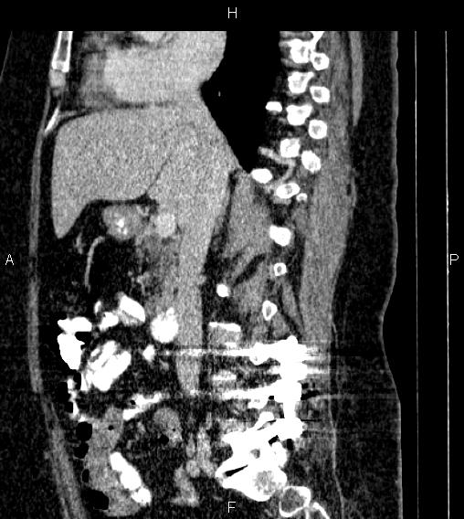 File:Adrenal myelolipoma (Radiopaedia 84319-99617 Sagittal renal cortical phase 41).jpg